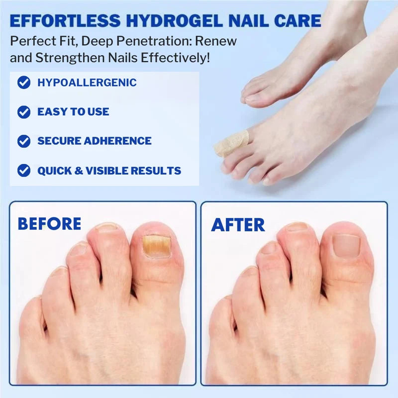 Nighttime Antifungal Nail Patches