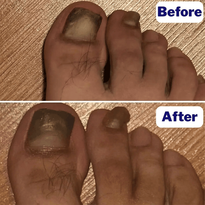 Nighttime Antifungal Nail Patches